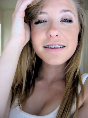 Girls with braces? Anyone? -..